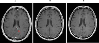 Case Report: Dual Checkpoint Inhibition in Advanced Metastatic Osteosarcoma Results in Remission of All Tumor Manifestations—A  Report of a Stunning Success in a 37-Year-Old Patient